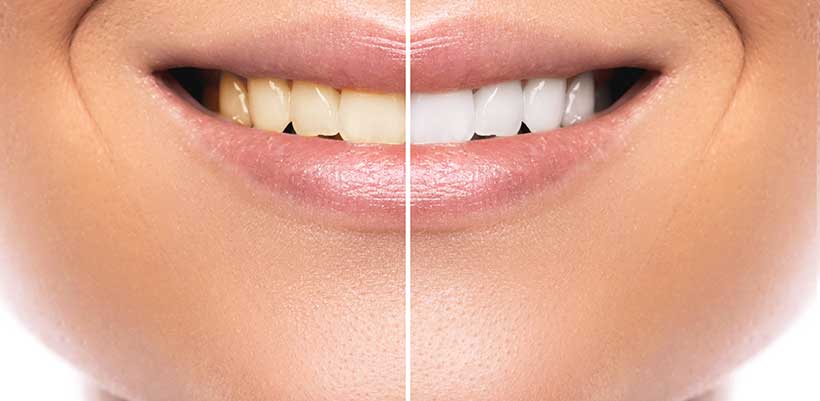 Are your favourite foods staining your teeth?